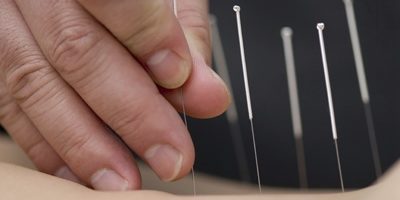 acupuncture